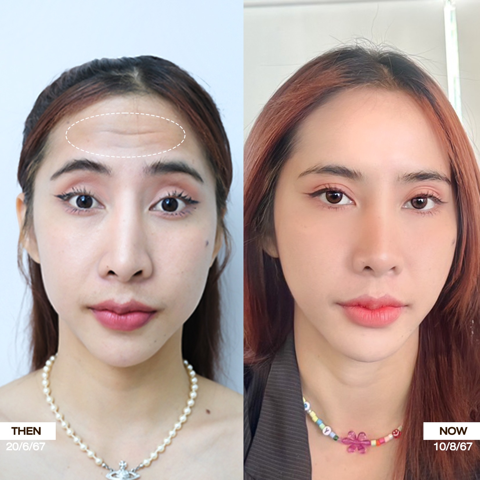 รีวิว โบท็อกซ์ Wandee Clinic รวมลิสต์ แนะนำ 5 คลินิก ฉีดโบท็อกซ์ พัทยา ยอดนิยม