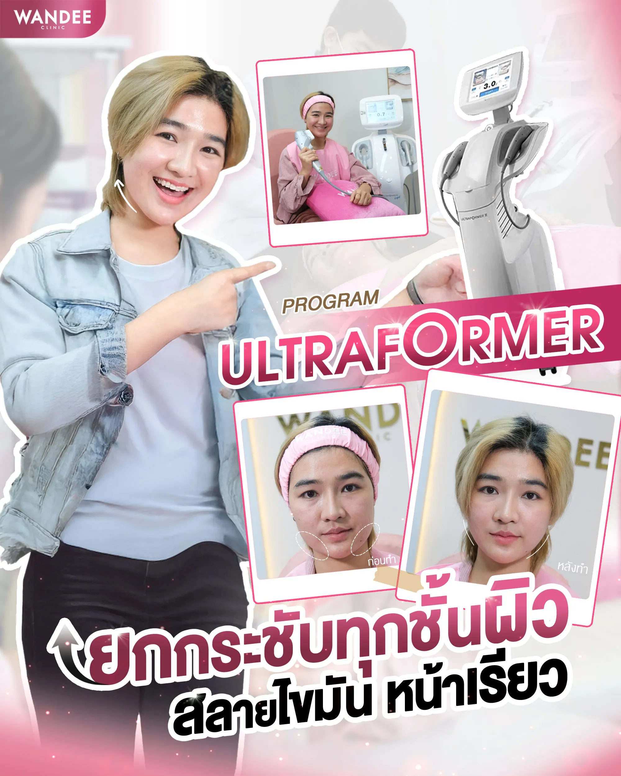 รีวีว Ultraformer Wandee Clinic