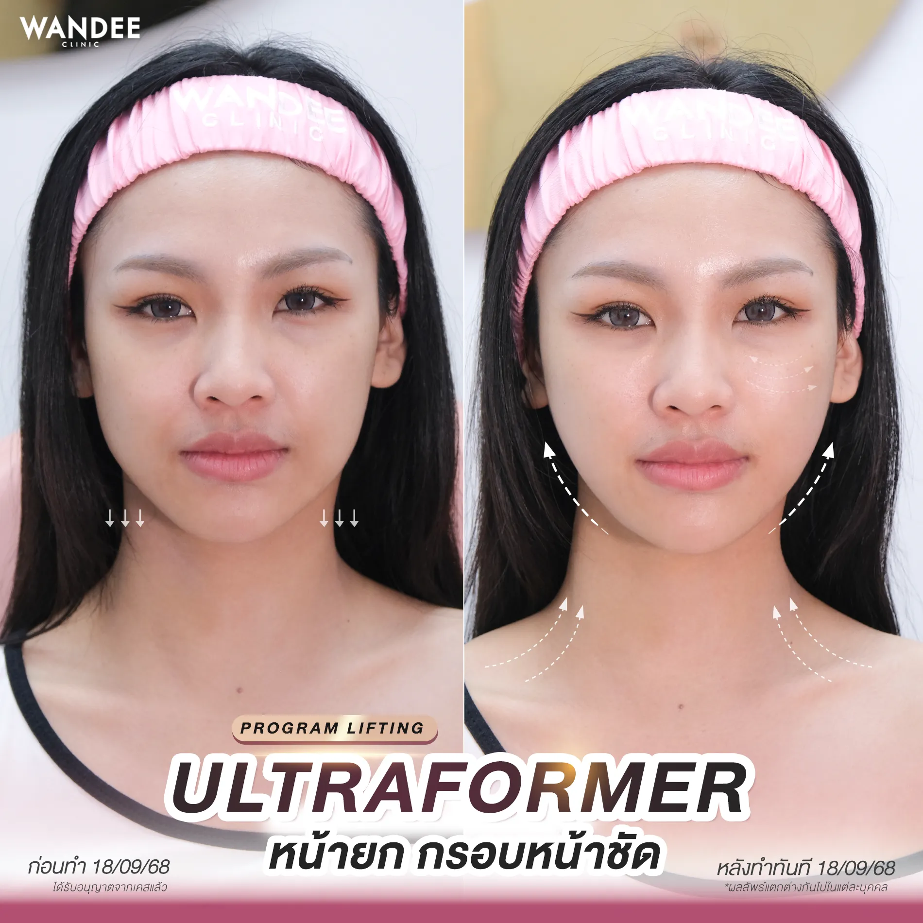 รีวีว Ultraformer Wandee Clinic