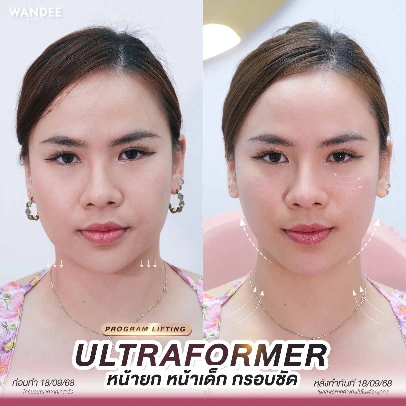 รีวีว Ultraformer Wandee Clinic