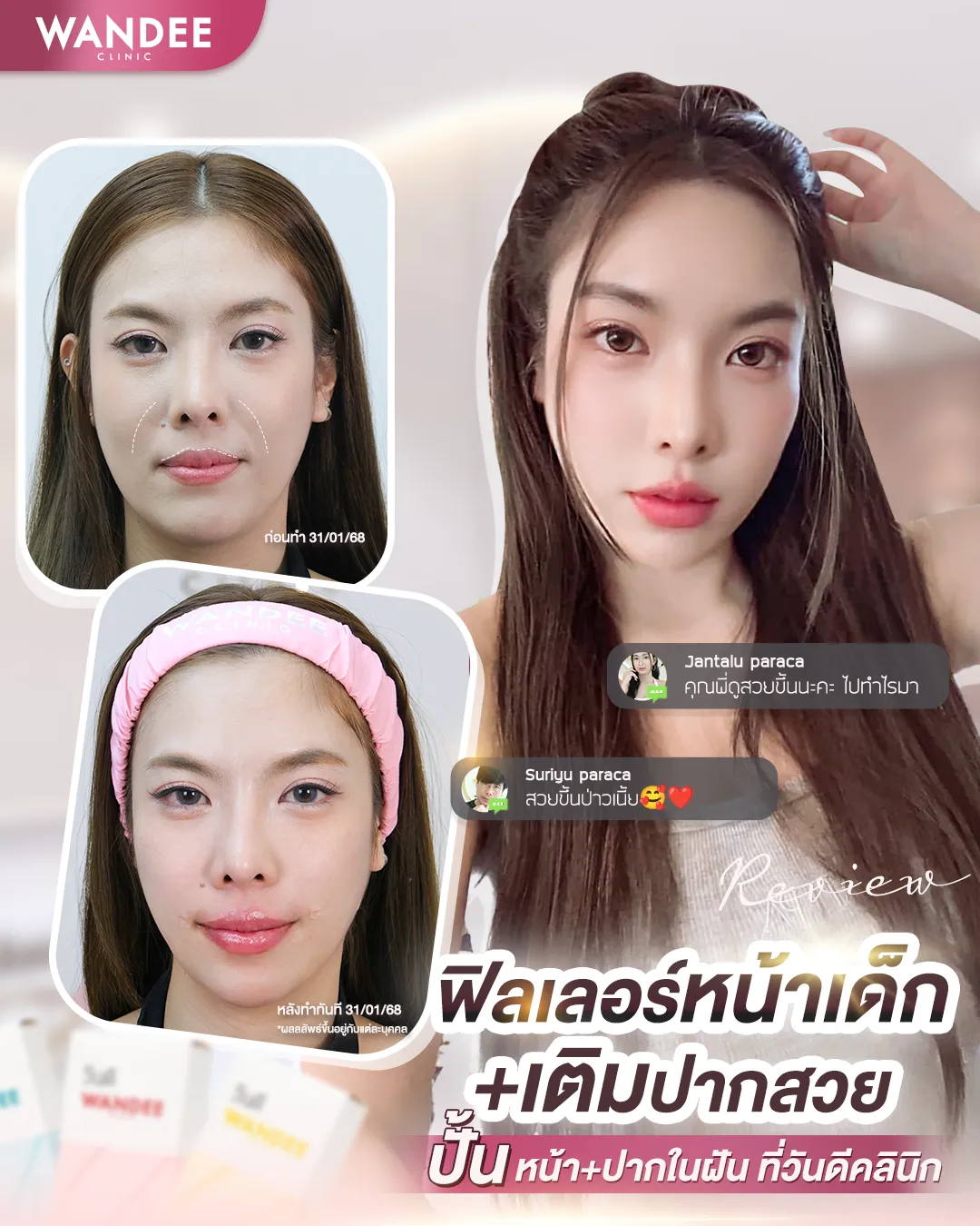 รีวิวฟิลเลอร์ร่องแก้ม Wandee Clinic