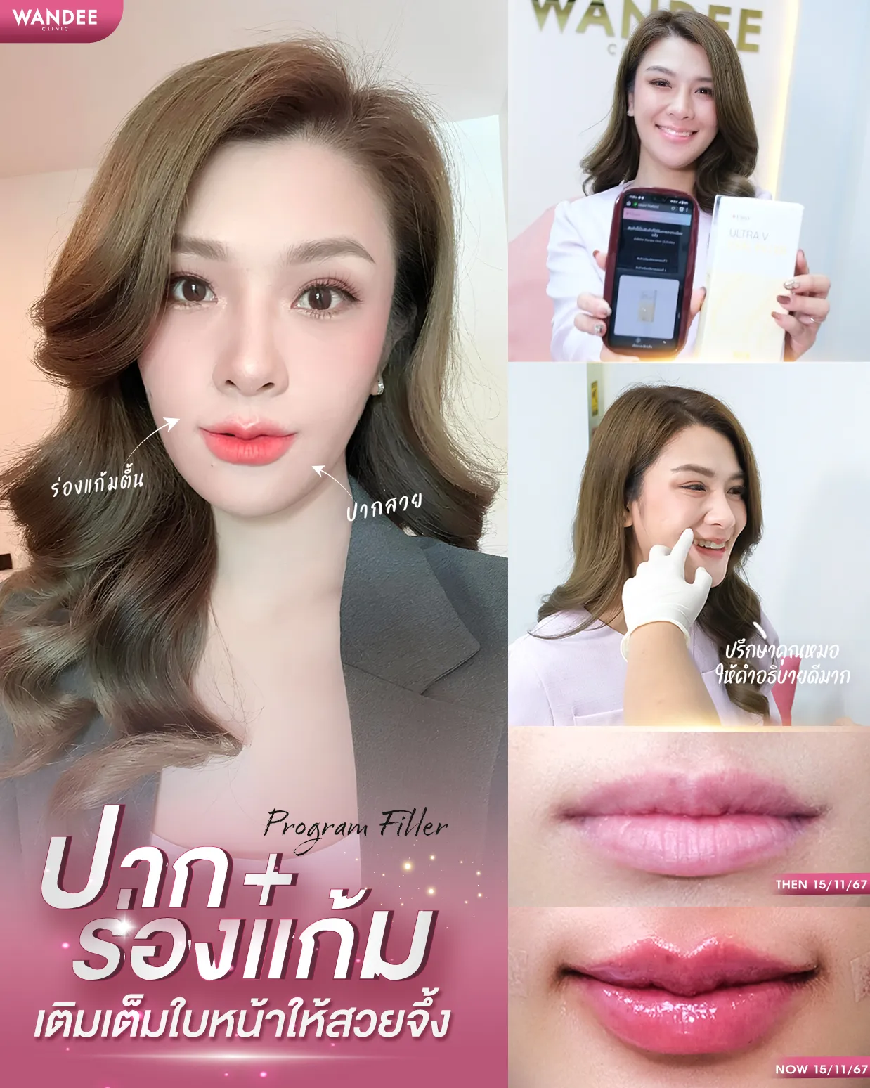 รีวิวฟิลเลอร์ร่องแก้ม Wandee Clinic