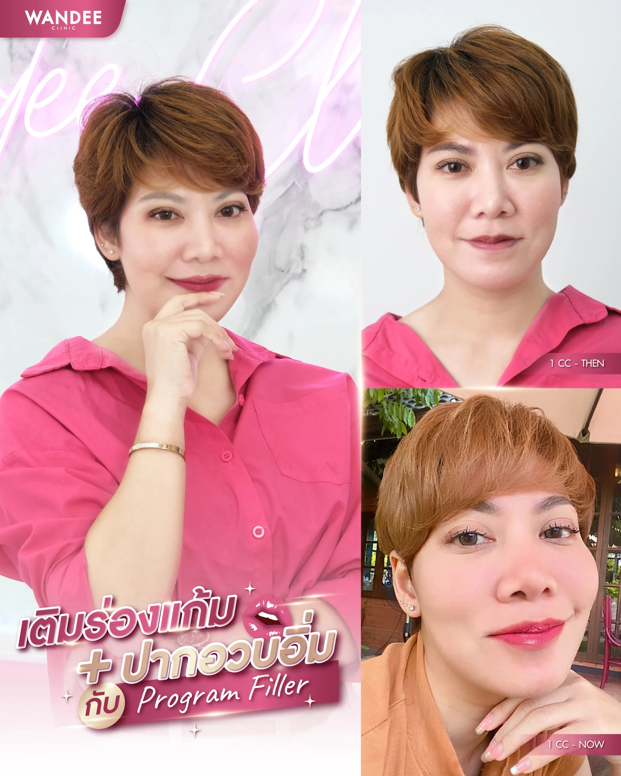 รีวิวฟิลเลอร์ร่องแก้ม Wandee Clinic