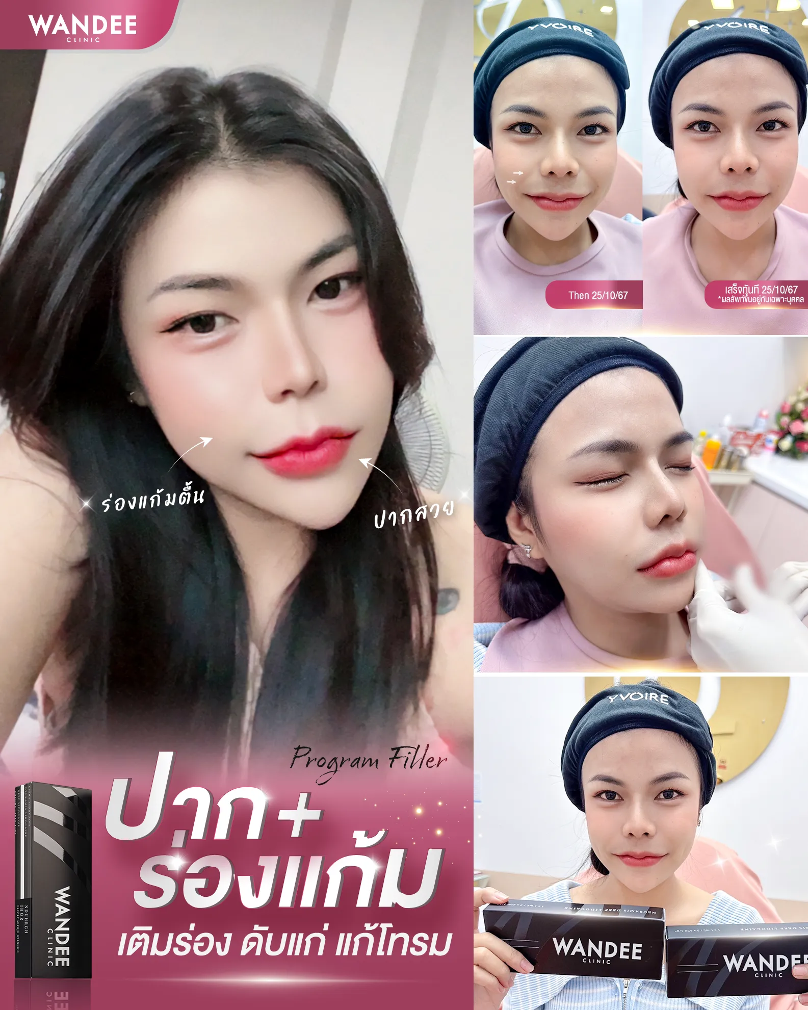 รีวิวฟิลเลอร์ร่องแก้ม Wandee Clinic