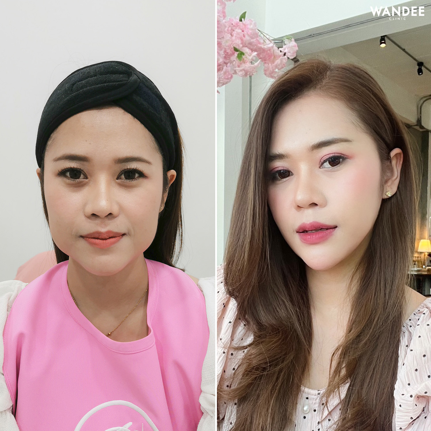 รีวิว โบท็อกซ์ Wandee Clinic รวมลิสต์ แนะนำ 5 คลินิก ฉีดโบท็อกซ์ พัทยา ยอดนิยม