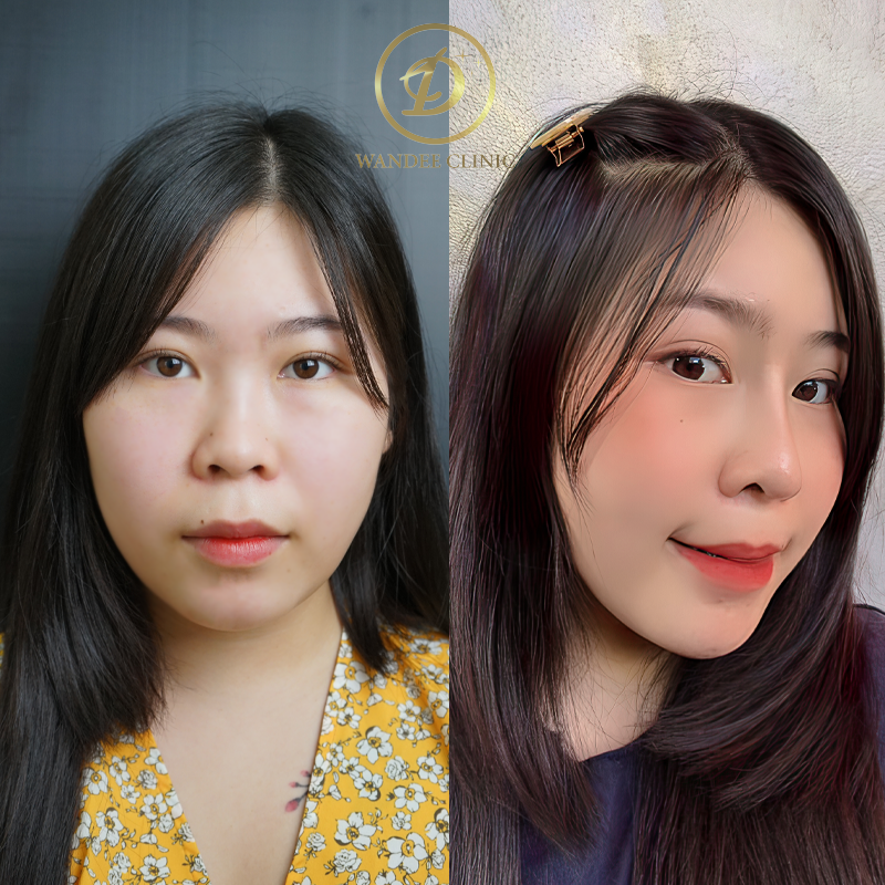 รีวิวเสริมจมูก วันดีคลินิก