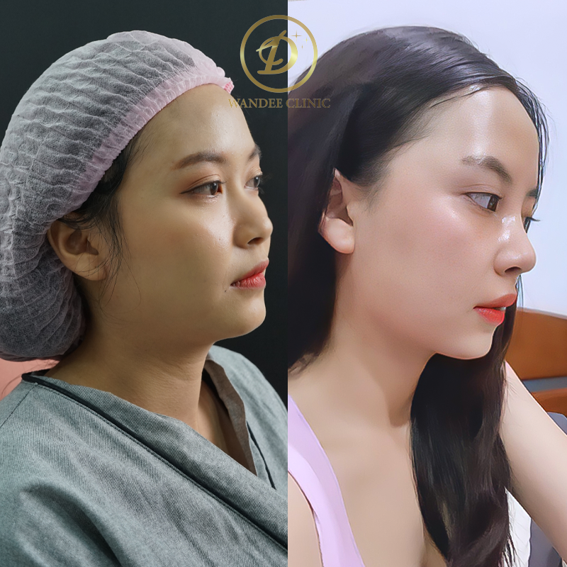 รีวิวเสริมจมูก วันดีคลินิก