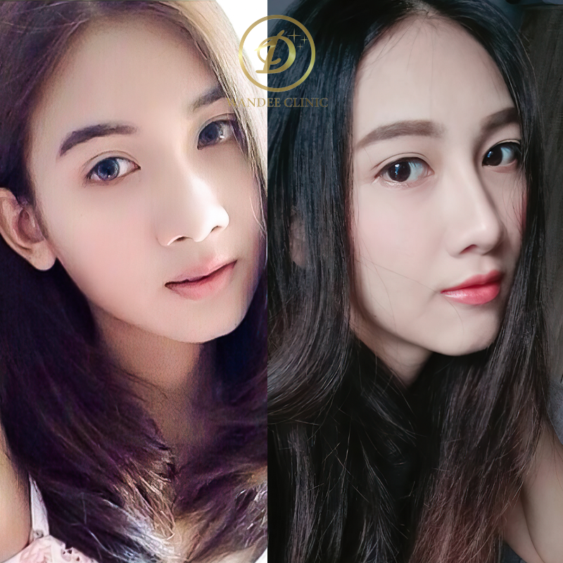 รีวิวเสริมจมูก วันดีคลินิก