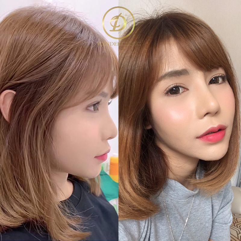 รีวิวเสริมจมูก วันดีคลินิก