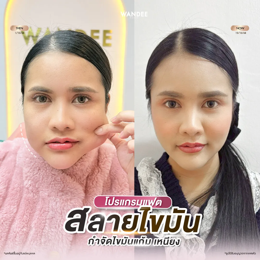รีวิว Meso Fat Wandee Clinic