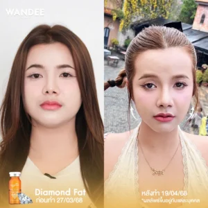 รีวิว Meso Fat Wandee Clinic