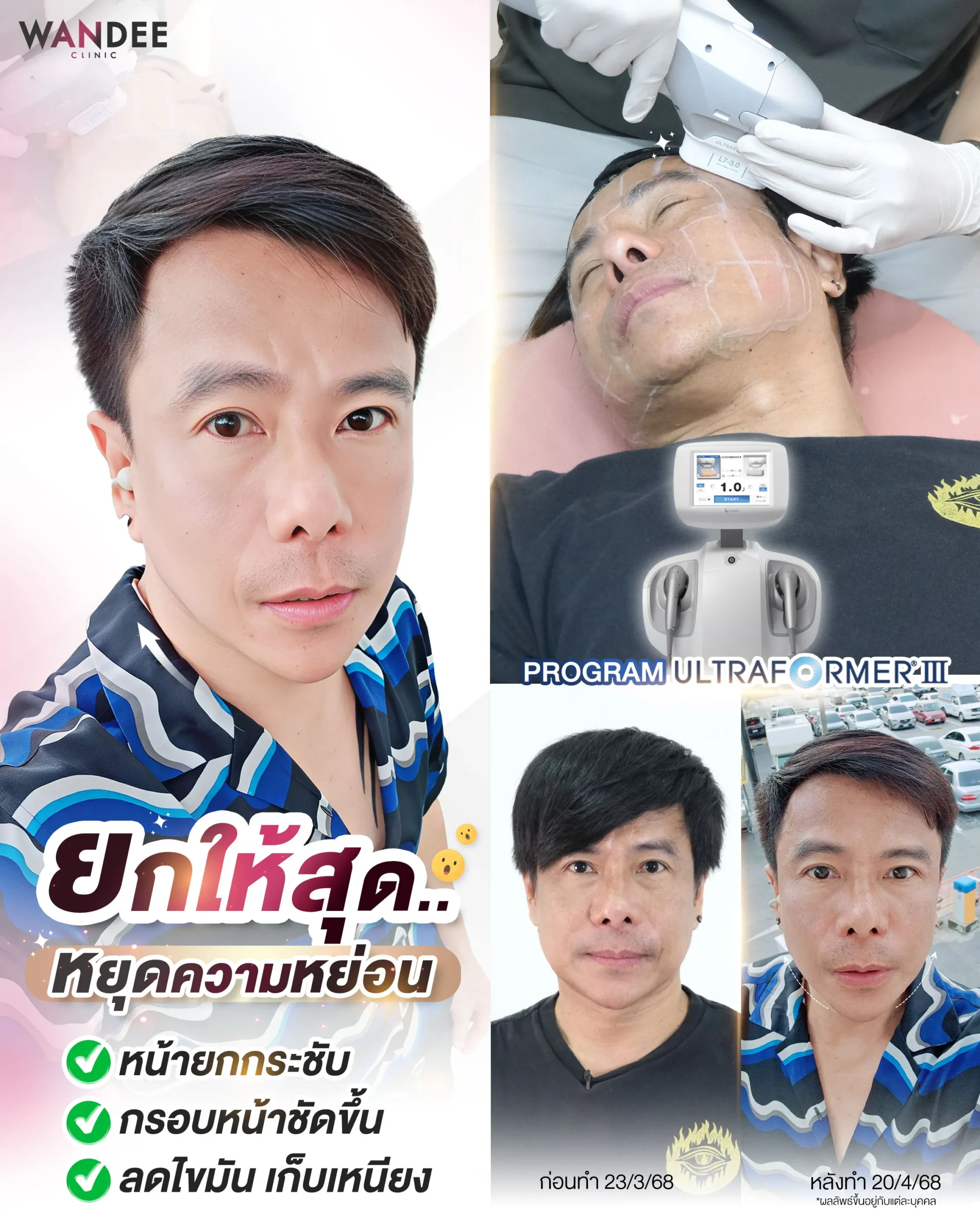 รีวิว Ultraformer ที่ Wandee Clinic