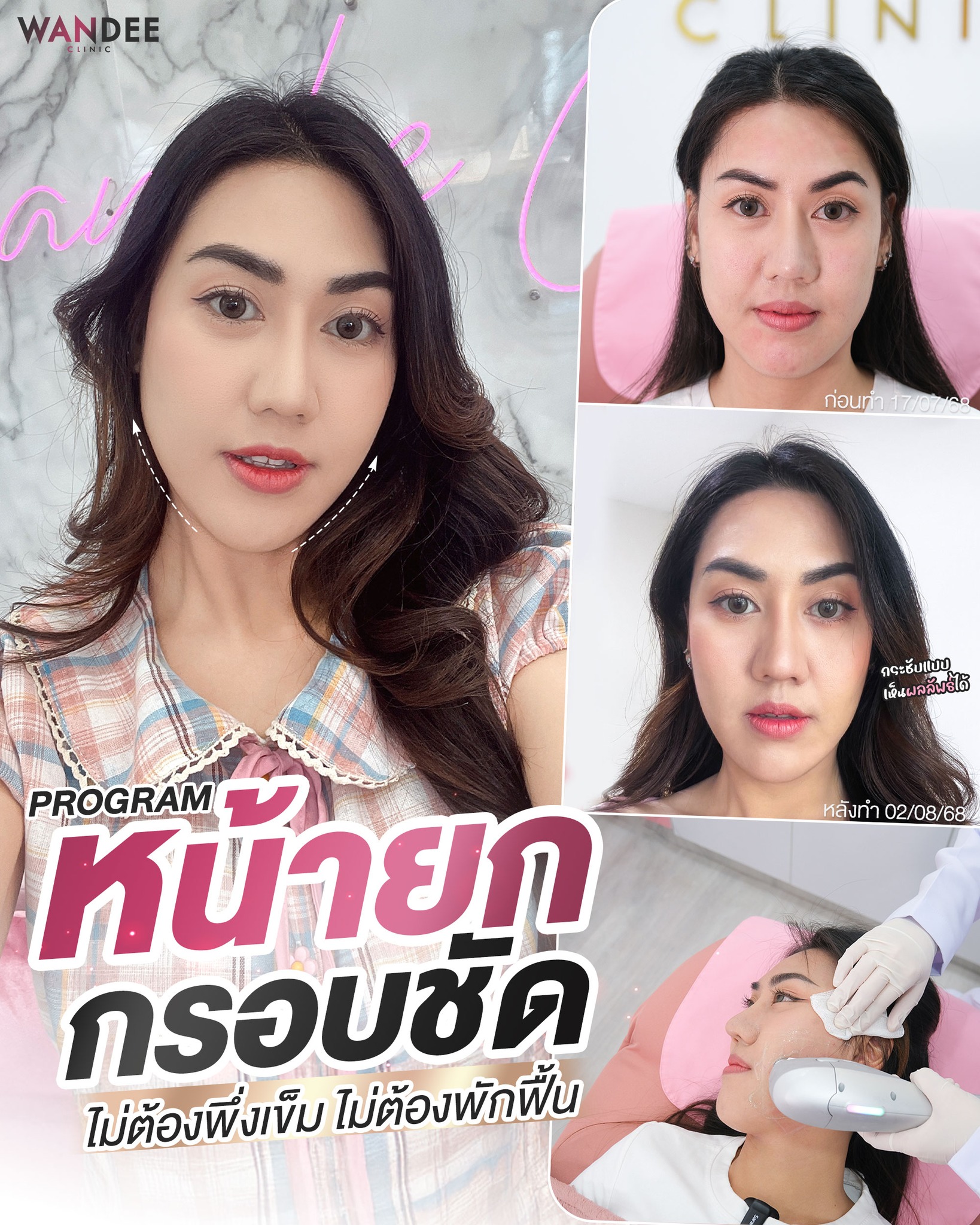 รีวิว โปรแกรมhifu Wandee Clinic2