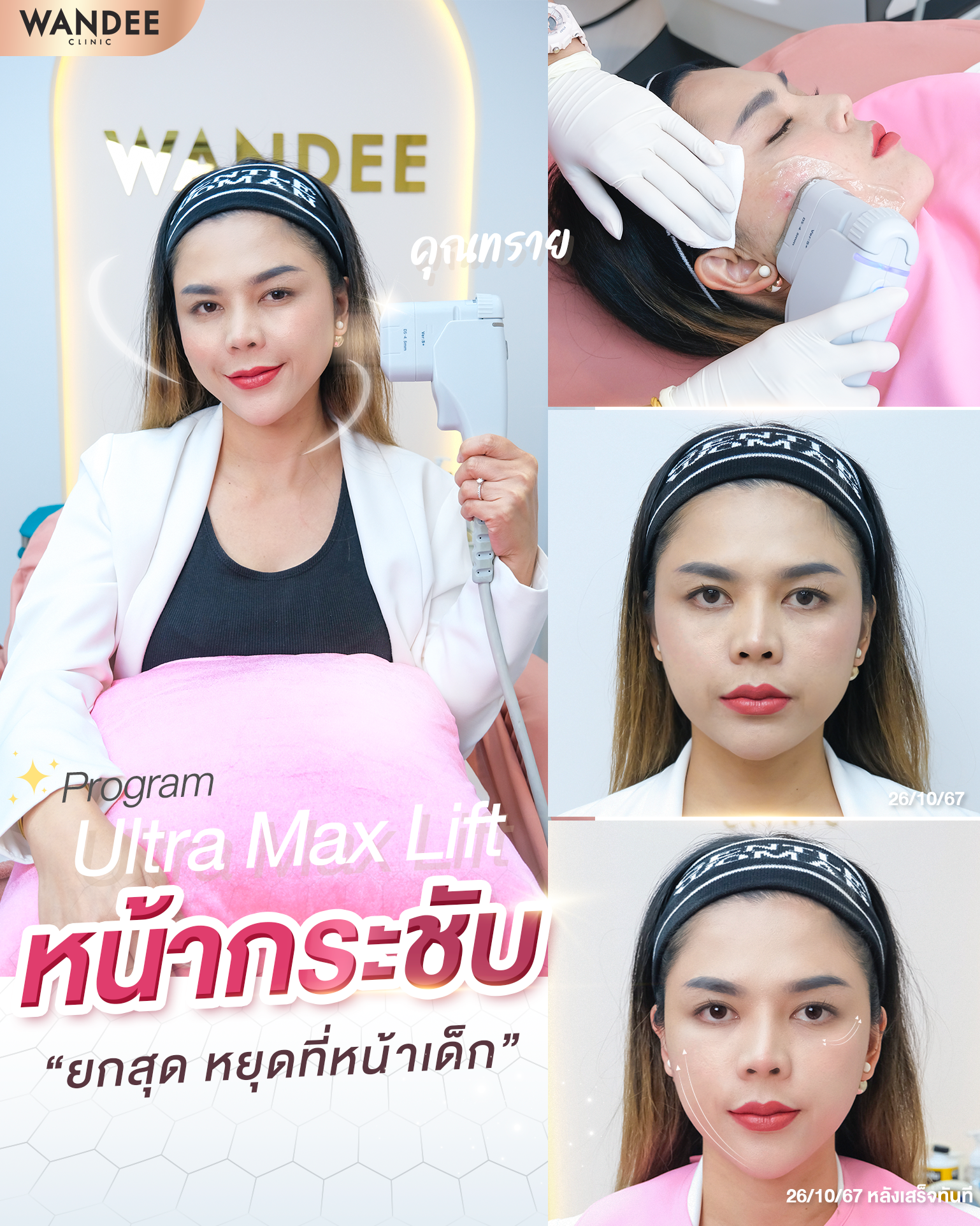 รีวิว โปรแกรมhifu Wandee Clinic2