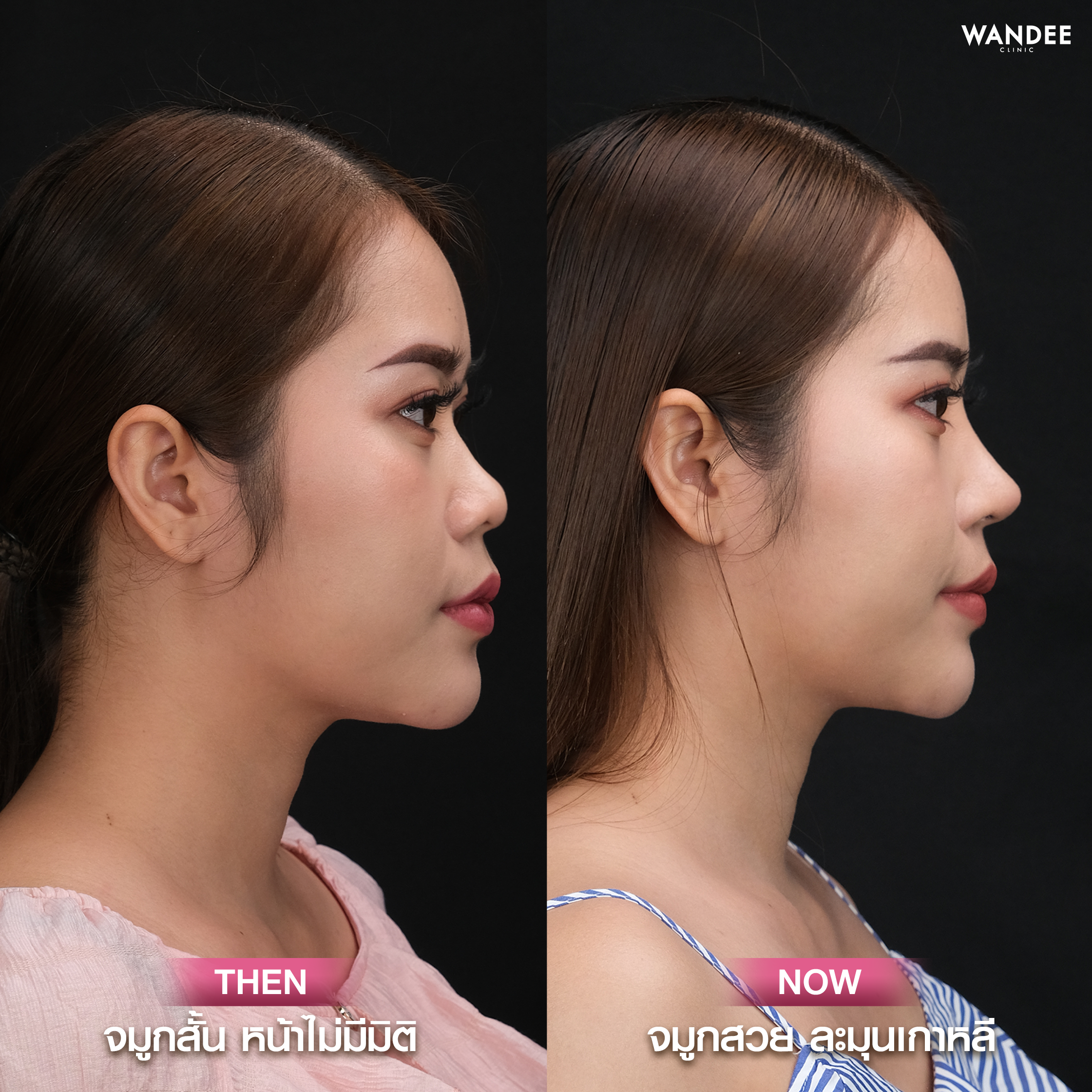 รีวิวเสริมจมูก Wandee Clinic