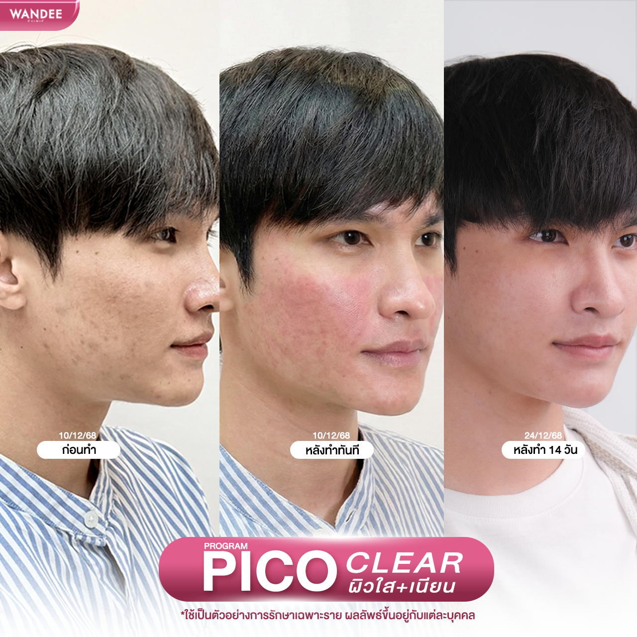 รีวิวโปรแกรม pico Wandee Clinic