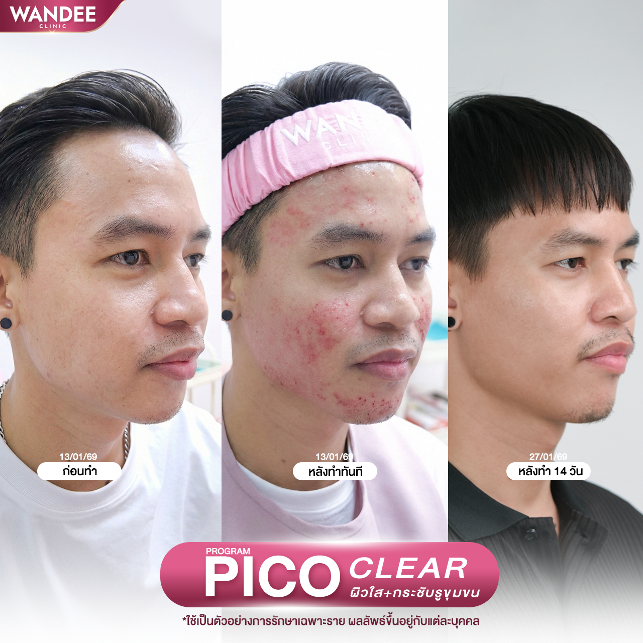 รีวิวโปรแกรม pico Wandee Clinic