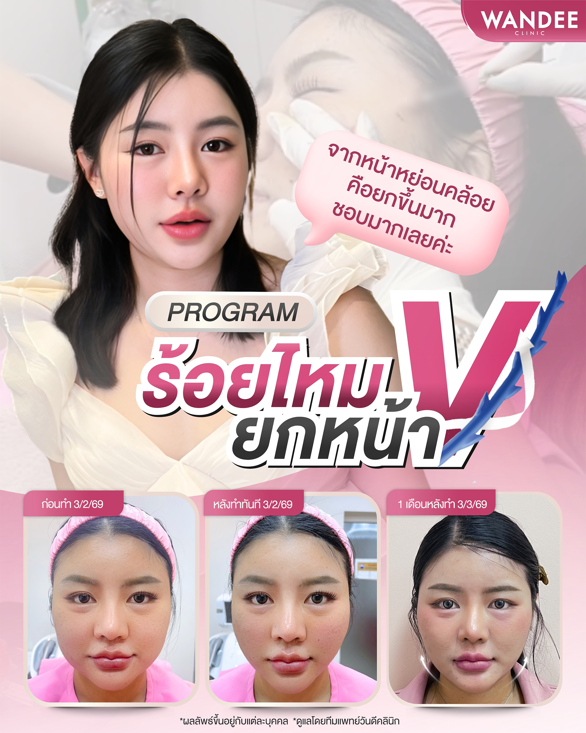 รีวิวโปรแกรมร้อยไหม Wandee Clinic
