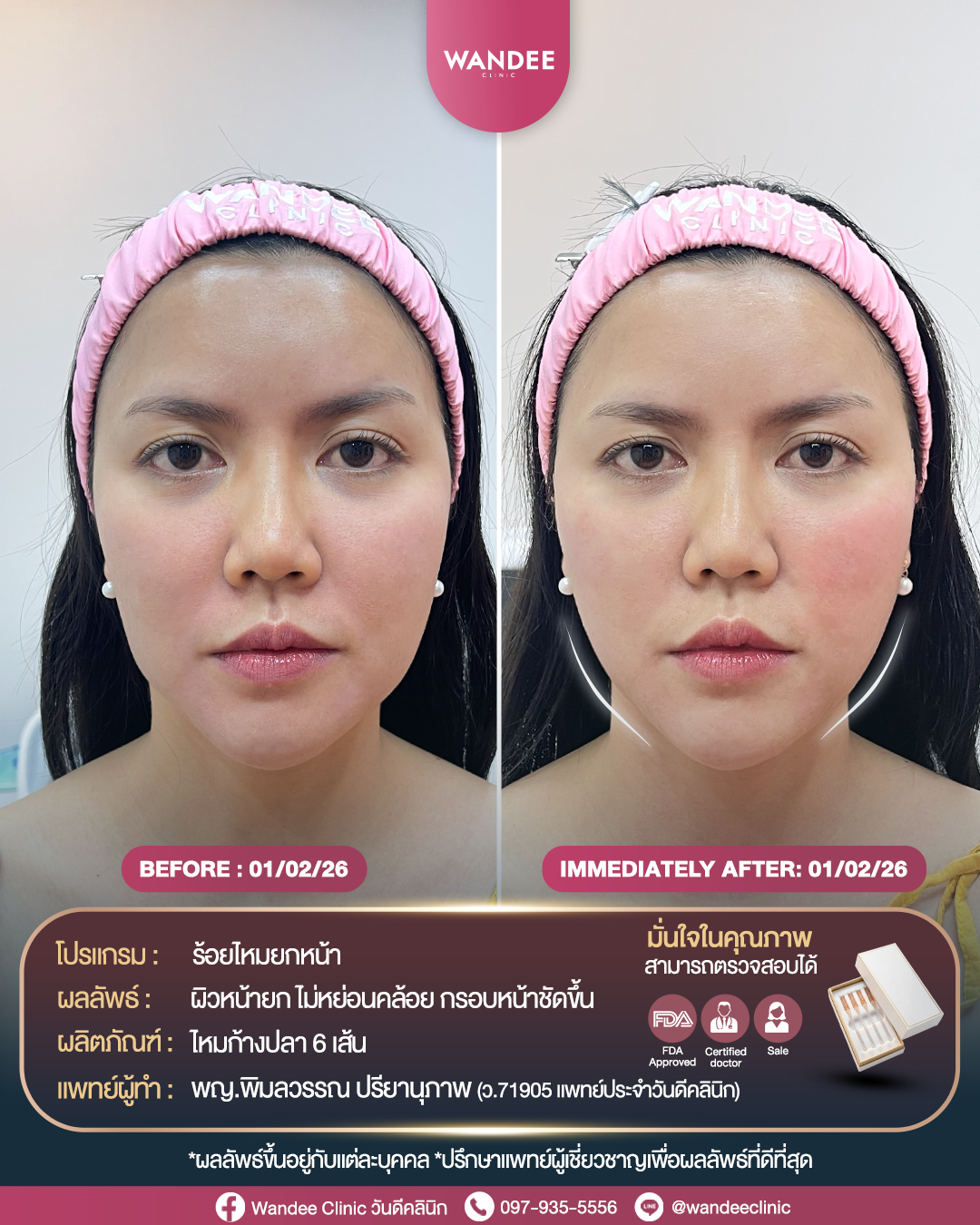 รีวิวโปรแกรมร้อยไหม Wandee Clinic
