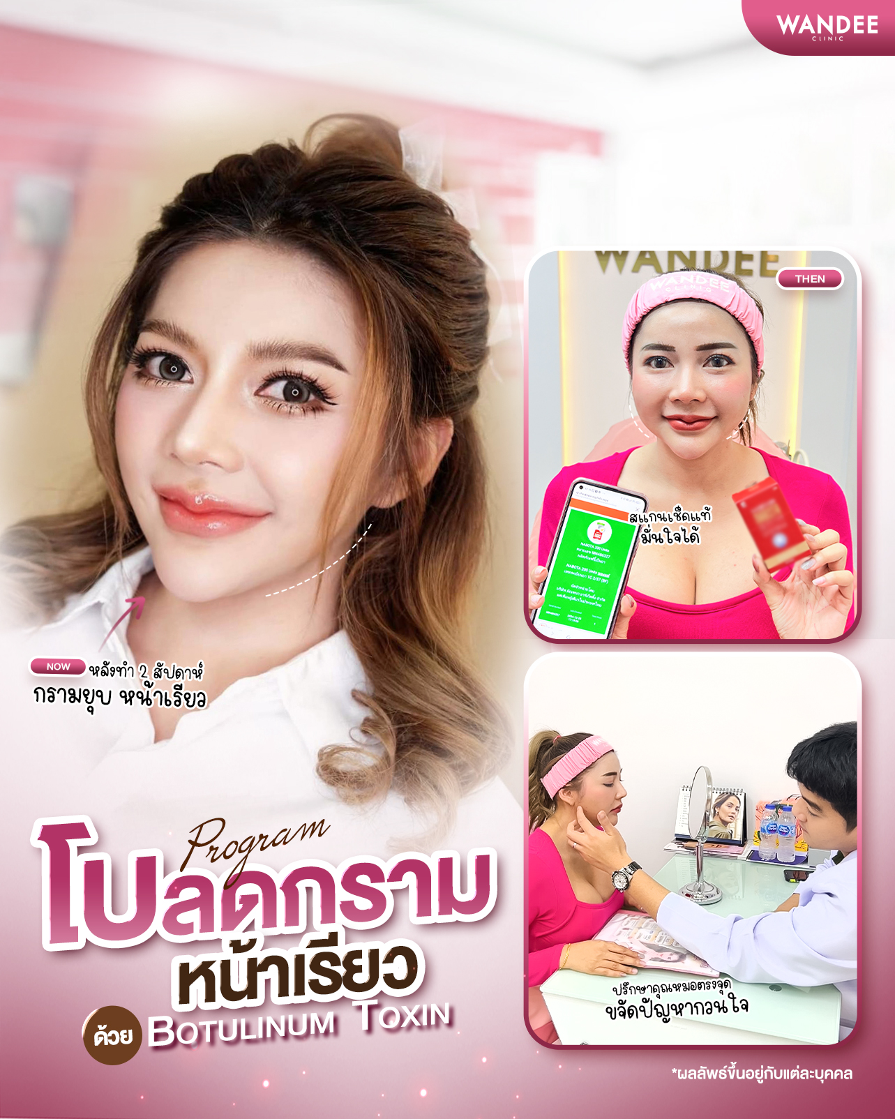 รีวิวโปรแกรม botox Wandee Clinic