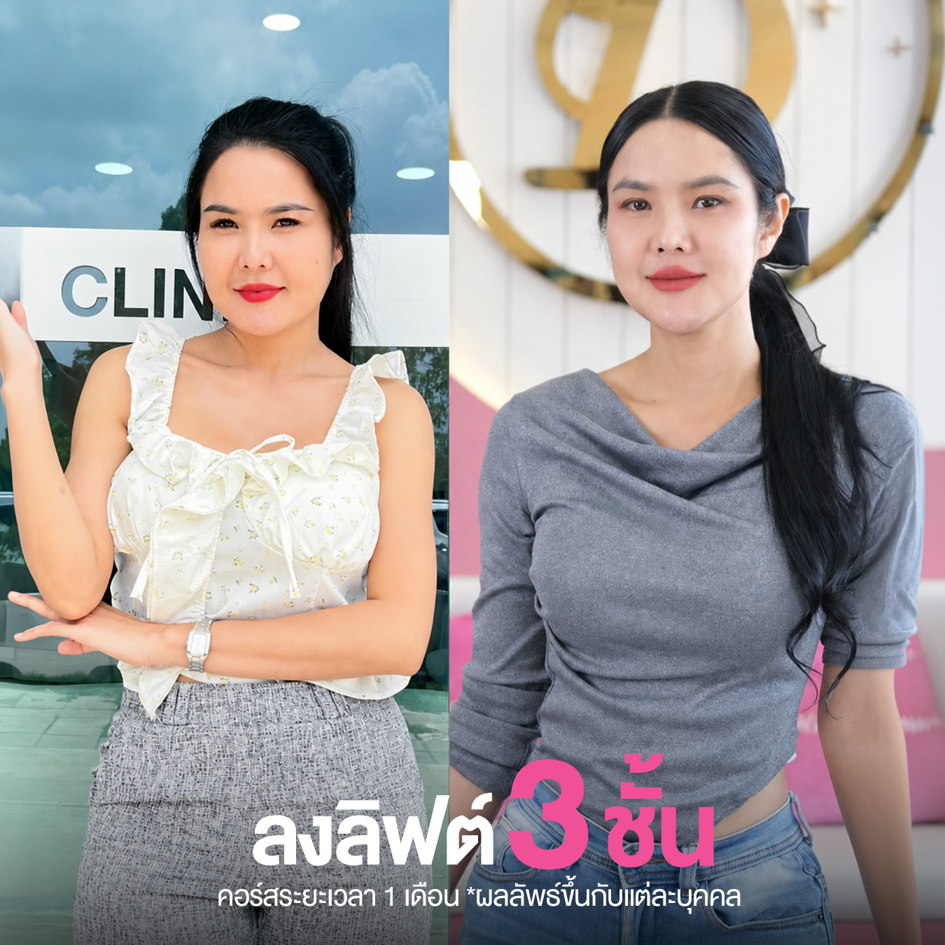รีวิวปักปากกาลดน้ำหนัก วันดี คลินิก