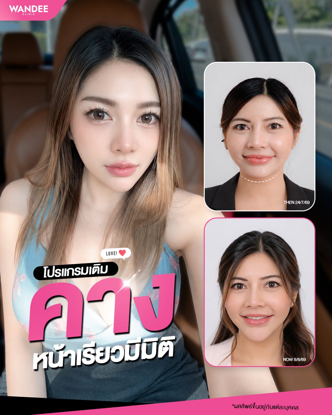 𝗣𝗿𝗼𝗴𝗿𝗮𝗺 𝗙𝗶𝗹𝗹𝗲𝗿 คาง